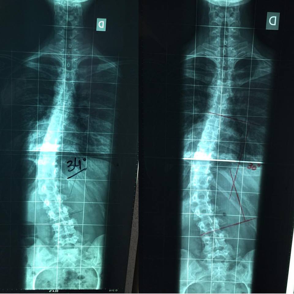 Respondendo a @achumalai Tratamento de Escoliose Severa Parte