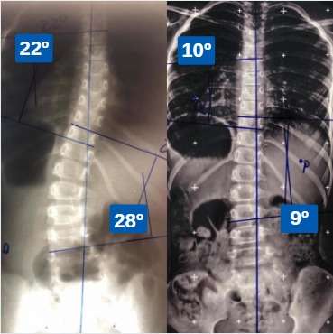 Esta imagem possuí um atributo alt vazio; O nome do arquivo é Escoliose-Brasil-Casos-Clínicos-1.jpeg