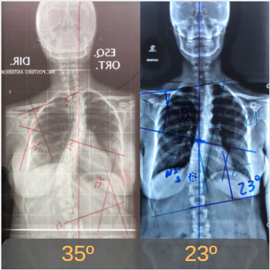 Esta imagem possuí um atributo alt vazio; O nome do arquivo é Escoliose-Brasil-Casos-Clínicos-Adulto-3.png